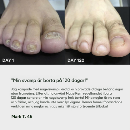 NagelRen | Gel för behandling av nagelsvamp