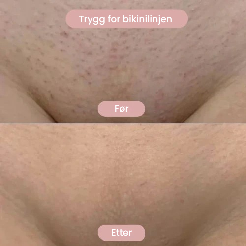 Silka™   – Intimbarbering uten irritasjon