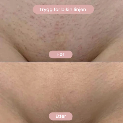 Silka™   – Intimbarbering uten irritasjon